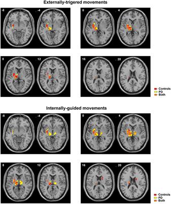 Hyperactivity of Basal Ganglia in Patients With Parkinson's Disease During Internally Guided Voluntary Movements